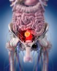 Ilustración médica del tumor rectal en el cuerpo humano . - foto de stock
