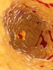 Ilustración de grasa dentro de la arteria humana . - foto de stock