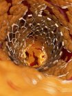Illustration du stent à l'intérieur de l'artère graisseuse humaine . — Photo de stock