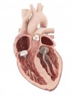 Illustration médicale de valvule cardiaque artificielle . — Photo de stock