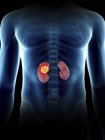 Ilustración del tumor renal en silueta masculina transparente . - foto de stock