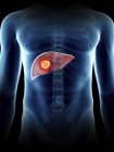 Ilustración del tumor hepático en silueta masculina transparente . - foto de stock