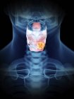 Illustrazione del tumore della laringe nella silhouette maschile trasparente . — Foto stock