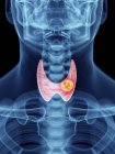 Ilustración del tumor tiroideo en silueta masculina transparente . - foto de stock