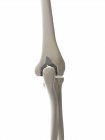Illustration of elbow implant in human skeleton. — Stock Photo