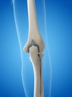 Illustrazione della protesi sostitutiva del gomito su fondo blu . — Foto stock
