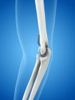 Illustration of elbow replacement prosthesis on blue background. — Stock Photo