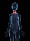 Ilustración de la silueta de mujer mayor que muestra el tumor de la glándula tiroides . - foto de stock