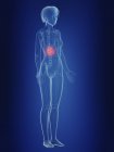 Illustrazione della silhouette femminile con reni dolorosi . — Foto stock