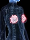 Medizinische Illustration entzündeter Brustdrüsen im menschlichen Körper. — Stockfoto