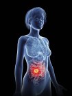 Illustrazione della silhouette femminile con cancro dell'intestino evidenziato . — Foto stock