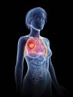 Illustration der weiblichen Silhouette mit hervorgehobenem Lungenkrebs. — Stockfoto