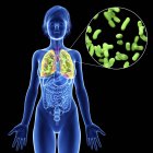 Illustration of female silhouette with highlighted lung infection. — Stock Photo