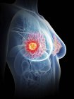 Ilustración de la silueta femenina con el cáncer de glándulas mamarias resaltado . - foto de stock