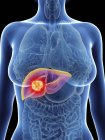 Ilustración de la silueta femenina con cáncer de hígado resaltado . - foto de stock