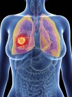 Ilustración de la silueta femenina con cáncer de pulmón resaltado . - foto de stock