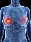 Ilustración de la silueta femenina con el cáncer de glándulas mamarias resaltado . - foto de stock