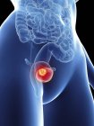 Illustration of female silhouette with highlighted bladder cancer. — Stock Photo