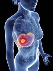 Ilustración de la silueta femenina con cáncer de hígado . - foto de stock