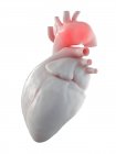 Illustration de l'anévrisme aortique dans le cœur humain . — Photo de stock