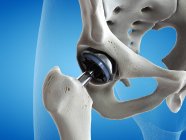 Illustration of hip replacement metal implant on blue background. — Stock Photo