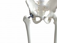 Ilustración del implante de metal de reemplazo de cadera sobre fondo blanco . - foto de stock