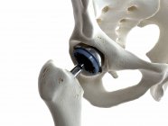 Ilustración del implante de metal de reemplazo de cadera sobre fondo blanco . - foto de stock