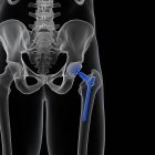 Illustrazione della sostituzione dell'anca medica su sfondo nero . — Foto stock