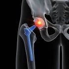 Illustrazione della sostituzione dell'anca dolorante su sfondo nero . — Foto stock