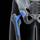 Illustrazione della sostituzione dell'anca medica su sfondo nero . — Foto stock