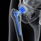 Ilustración del reemplazo médico de cadera sobre fondo negro . - foto de stock