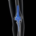Illustrazione della sostituzione del gomito nello scheletro umano . — Foto stock