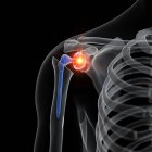 Illustrazione della sostituzione della spalla dolorante nello scheletro umano . — Foto stock