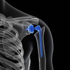 Illustrazione della sostituzione della spalla nello scheletro umano . — Foto stock