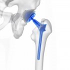 Illustrazione della protesi di sostituzione dell'anca su fondo bianco . — Foto stock