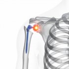 Illustration of shoulder replacement implant with pain on white background. — Stock Photo