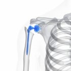 Ilustración del implante de reemplazo de hombro sobre fondo blanco . - foto de stock