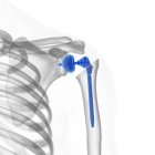 Illustration of shoulder replacement implant on white background. — Stock Photo