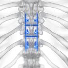 Ilustración de la fusión espinal en el esqueleto humano . - foto de stock