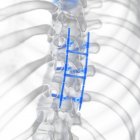 Illustration de la fusion rachidienne dans le squelette humain . — Photo de stock