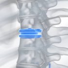 Illustration der blauen Bandscheibenersatzprothese. — Stockfoto