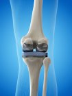 Illustration of knee replacement implant on blue background. — Stock Photo