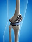 Illustration of knee replacement implant on blue background. — Stock Photo