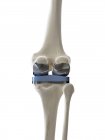 Ilustración de prótesis de reemplazo de rodilla sobre fondo blanco . - foto de stock