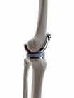 Illustrazione della protesi di sostituzione del ginocchio su fondo bianco . — Foto stock