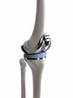 Illustrazione della protesi di sostituzione del ginocchio su fondo bianco . — Foto stock