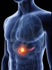 Ilustración de silueta azul transparente del cuerpo masculino con tumor de páncreas coloreado
. - foto de stock