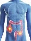 Illustration of transparent blue silhouette of male body with colored colon cancer. — Stock Photo