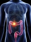 Illustration of transparent blue silhouette of male body with colored colon cancer. — Stock Photo