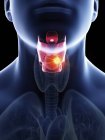 Illustration du cancer du larynx dans la silhouette du corps masculin, gros plan . — Photo de stock